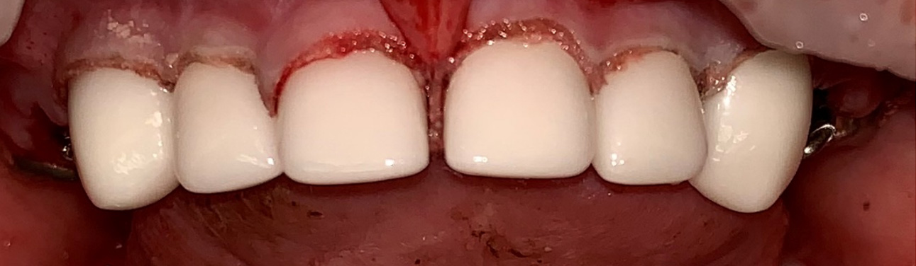 After Silver Diamine Fluoride Treatment