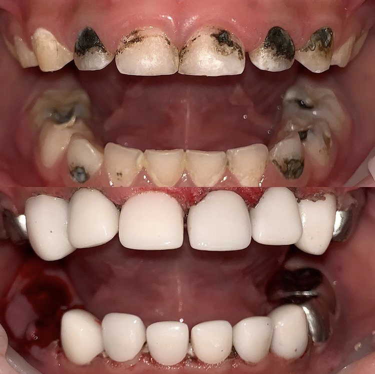 After Silver Diamine Fluoride Treatment
